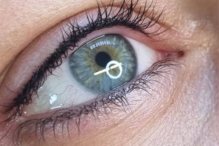 Wimpernkranzverdichtung PMU Stuttgart